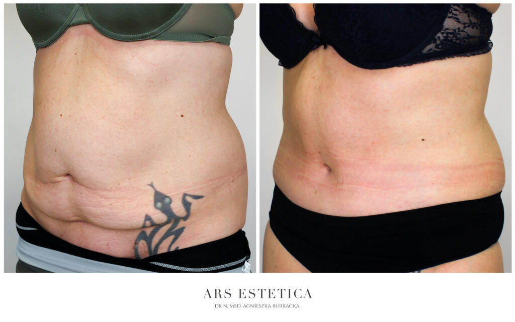 abdominoplastyka z liposukcją przed i po