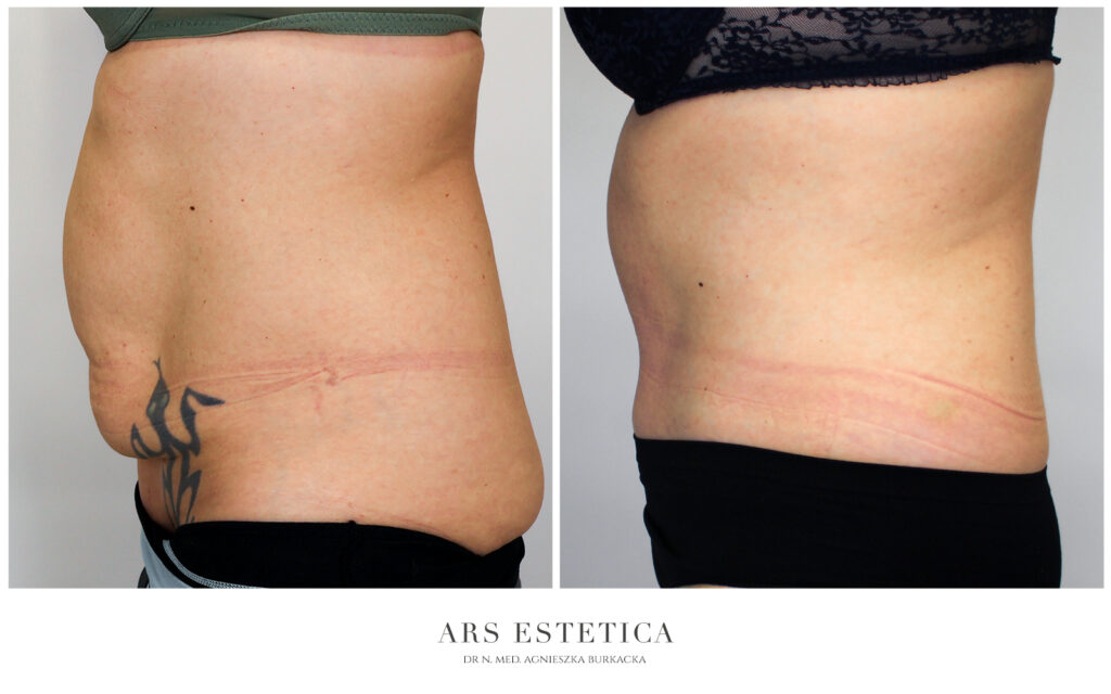 abdominoplastyka z liposukcją przed i po