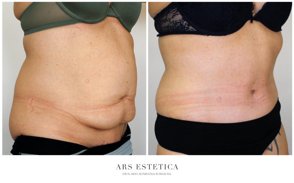 abdominoplastyka z liposukcją przed i po