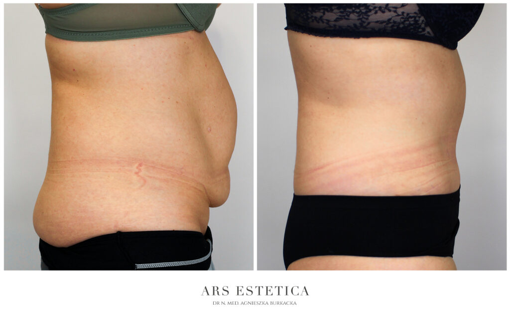 abdominoplastyka z liposukcją przed i po