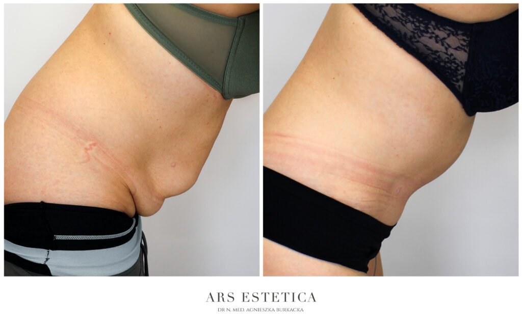 abdominoplastyka z liposukcją przed i po