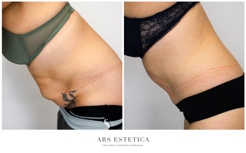 abdominoplastyka z liposukcją przed i po