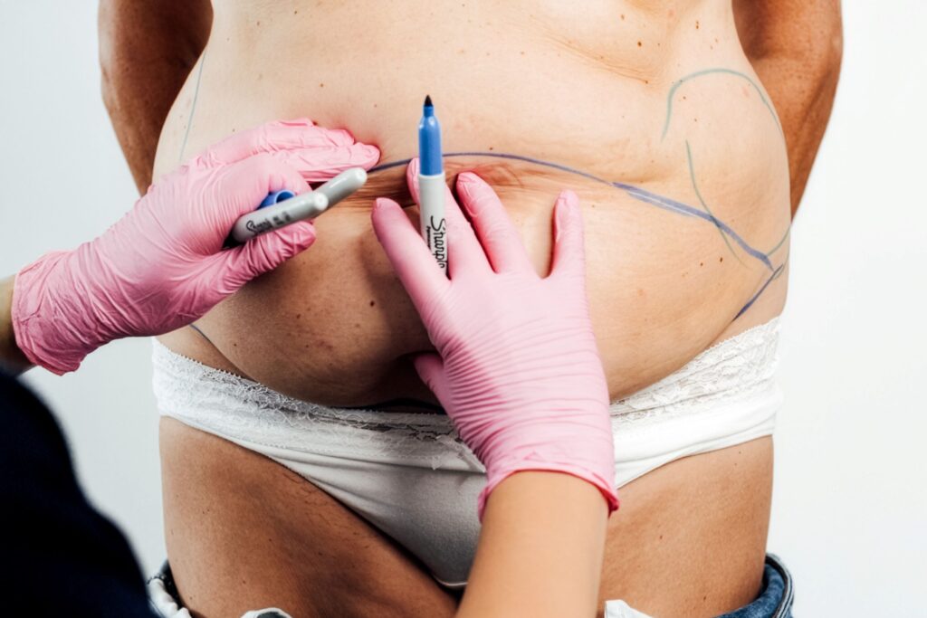 liposukcja dr Burkacka