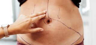 Mommy Makeover – kompleksowa metamorfoza po ciąży krok po kroku