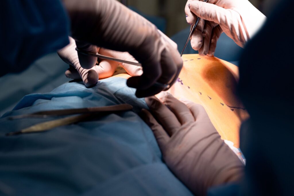 usuwanie implantów piersiowych